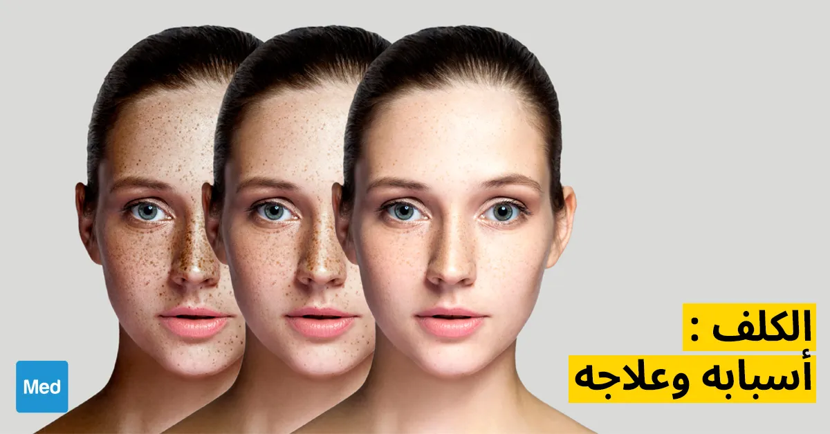 الكلف : أسبابه وعلاجه